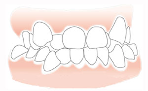牙列拥挤