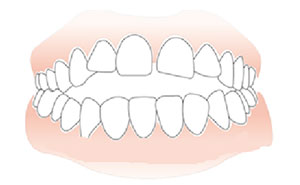 前牙开颌