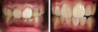 牙结石洗牙案例
